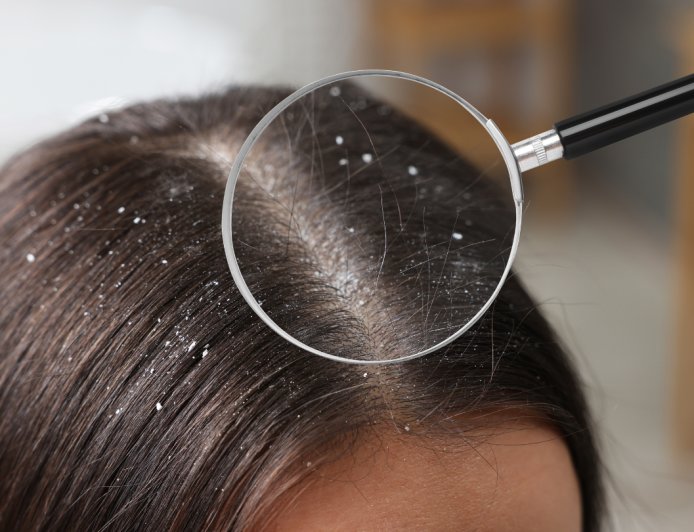 Summer Scalp Care Tips: How to Beat the Heat and Keep Hair Healthy